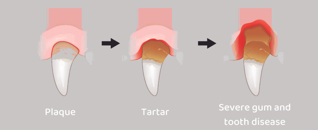 tartar process